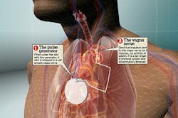 Machinedesign Com Sites Machinedesign com Files Uploads 2015 04 The Pacemaker Style Electronic Implant To Combat Arthritis
