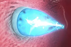 Machinedesign Com Sites Machinedesign com Files Uploads 2015 03 Uv Light Catheter 400x265 Machinedesign Com Sites Machinedesign com Files Uploads 2015 03 Uv Light Catheter 400x265