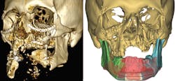Machinedesign Com Sites Machinedesign com Files Uploads 2016 10 12 Image 1 Cad Bone Surgery Machinedesign Com Sites Machinedesign com Files Uploads 2016 10 12 Image 1 Cad Bone Surgery