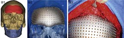 Machinedesign Com Sites Machinedesign com Files Uploads 2016 10 12 Image 2 Cad Skull Surgery Machinedesign Com Sites Machinedesign com Files Uploads 2016 10 12 Image 2 Cad Skull Surgery