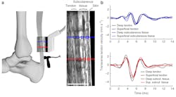 Www Machinedesign Com Sites Machinedesign com Files Tendon Measuring 0 Www Machinedesign Com Sites Machinedesign com Files Tendon Measuring 0