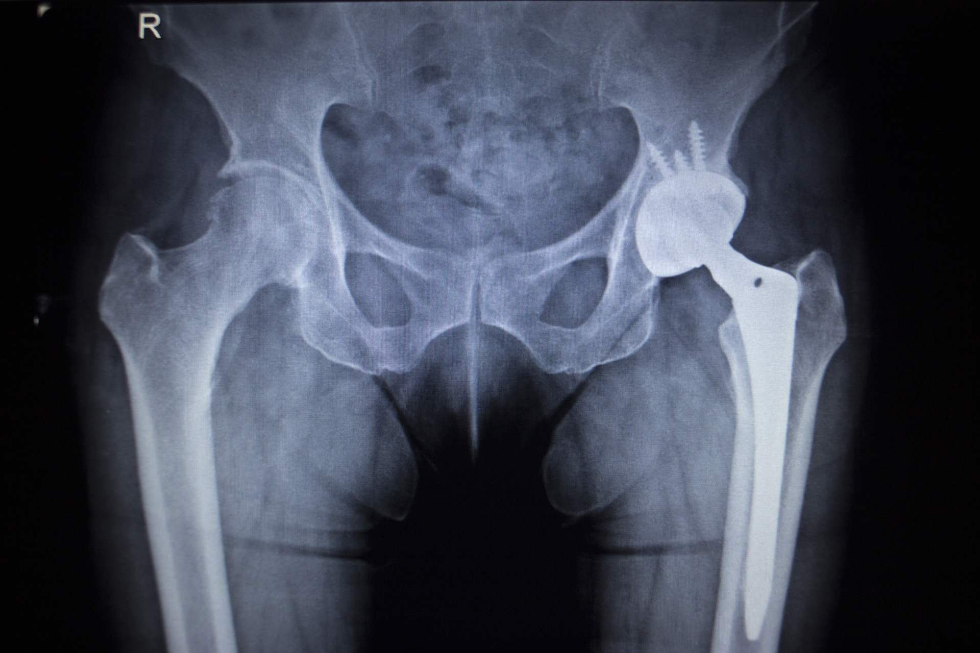 Hip Implant