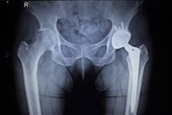 Hip Implant Hip Implant