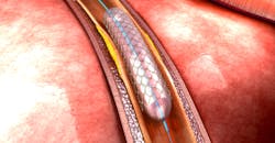 Stent Stent