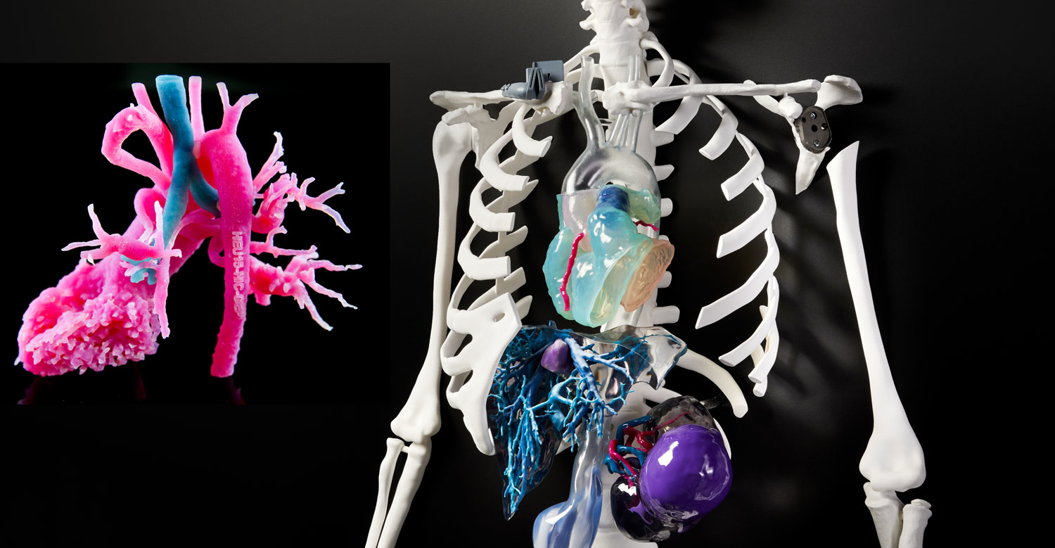 3D models and implants