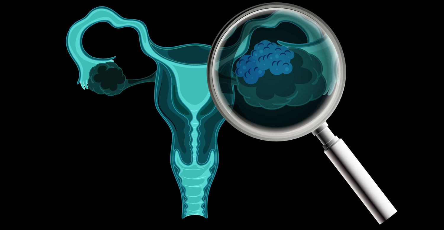Ovarian cancer