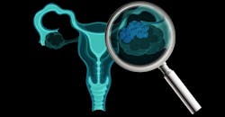 Ovarian cancer Ovarian cancer