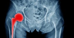 Hip implant Hip implant