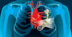 Piezo-Based Energy Harvesting for Medical Implants May Transcend Alternative Approaches Piezo-Based Energy Harvesting for Medical Implants May Transcend Alternative Approaches