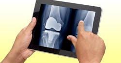 Knee replacement Knee replacement