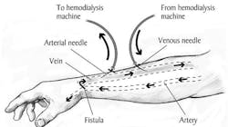 Machinedesign Com Sites Machinedesign com Files G1 Dialysis Machinedesign Com Sites Machinedesign com Files G1 Dialysis