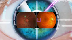 Eye surgery