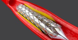 Stent Stent