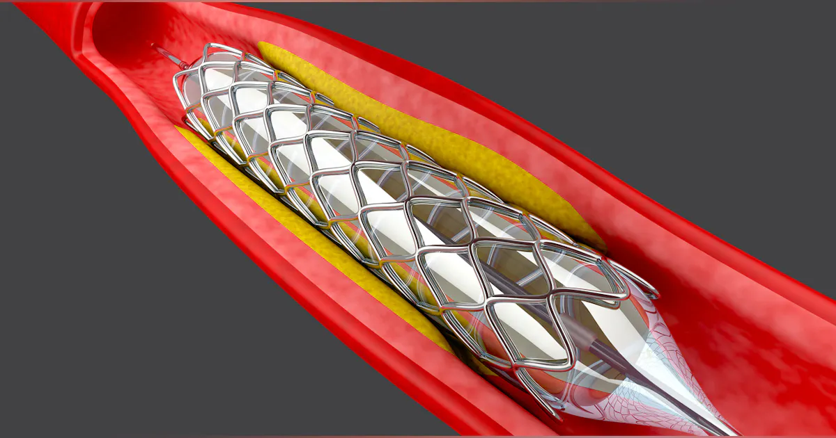 Coronary Stent Market to Hit $8 Billion by 2025 | Machine Design