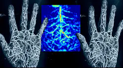 photoacoustic imaging
