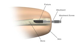 After the first surgical operation, the connector—a titanium implant—is inserted and fixed to the lower end of the femur. After the first surgical operation, the connector—a titanium implant—is inserted and fixed to the lower end of the femur.