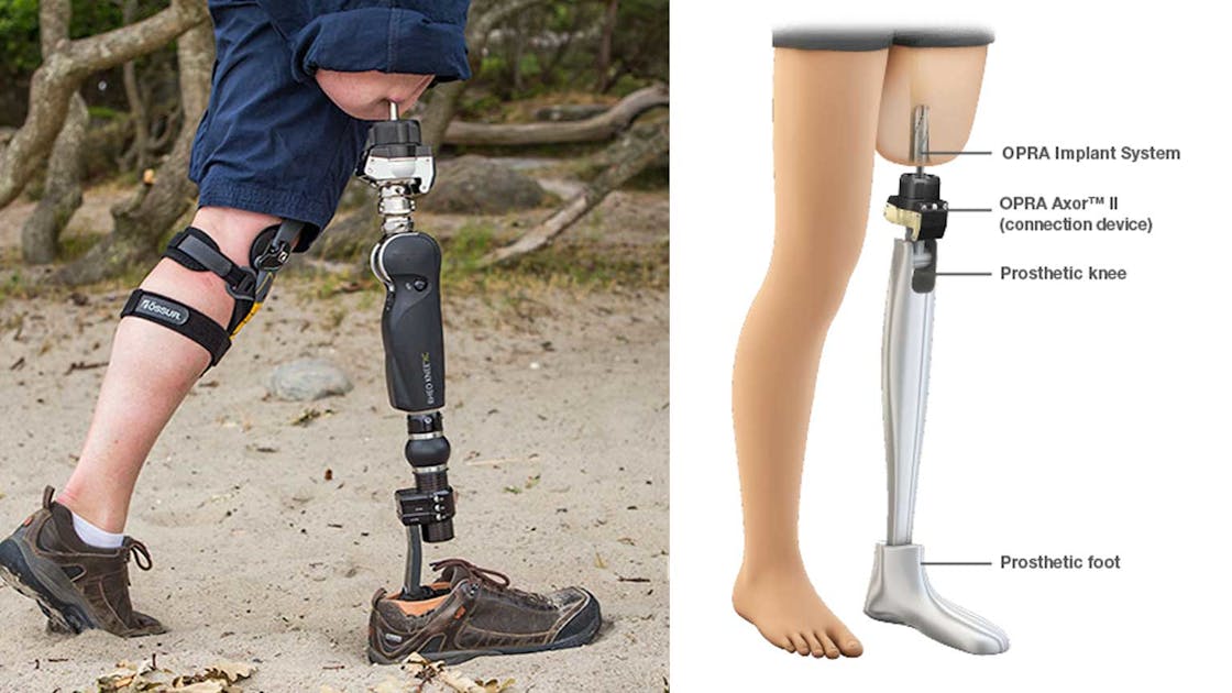 Above Knee Prosthetic Limbs