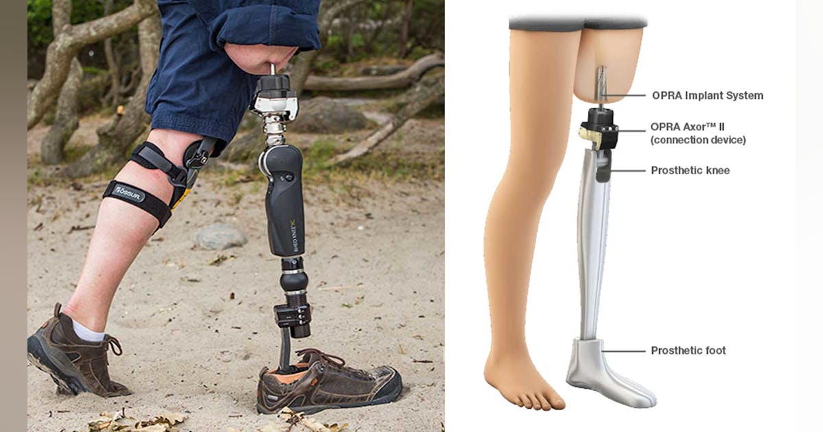 FDA Approves Implant for Adults with Above-the-Knee Amputations | Machine Design