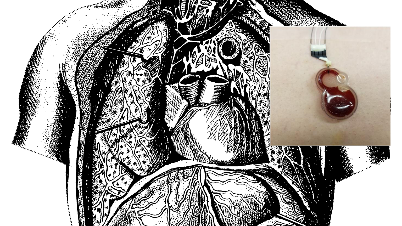 Circulatory system with inset of sensor