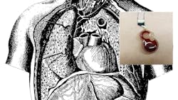Circulatory system with inset of sensor Circulatory system with inset of sensor