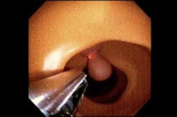 6. The next step involved pre-clinical-trial testing on simulated lesions in an artificial colon. 6. The next step involved pre-clinical-trial testing on simulated lesions in an artificial colon.