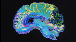 MRI image of a brain
