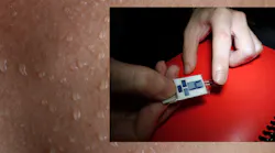 Hydrogel collecting sweat
