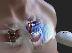 Schematic illustration of wirelessly charging a body-implanted electronic device using an ultrasonic probe. Schematic illustration of wirelessly charging a body-implanted electronic device using an ultrasonic probe.