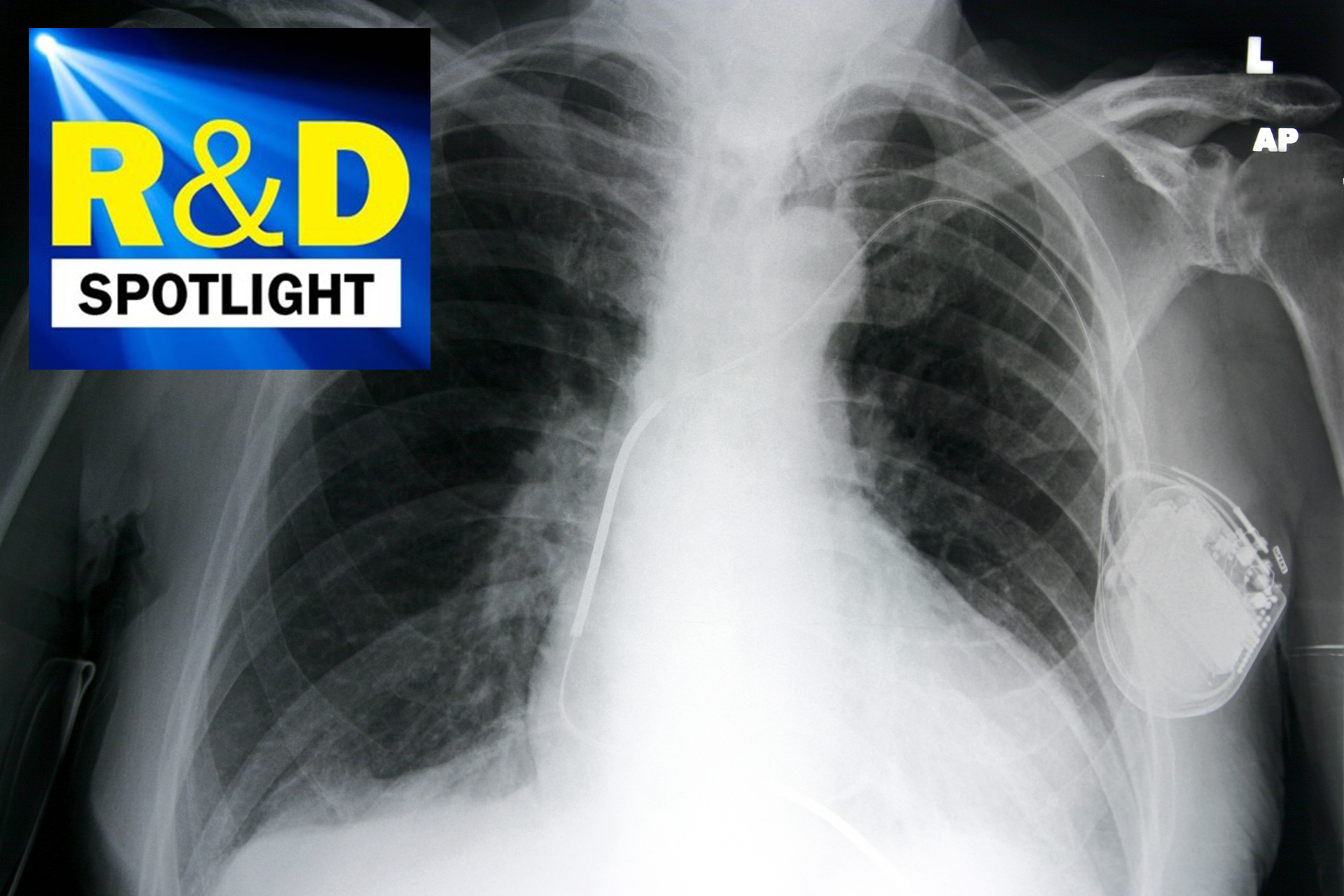 R D Spotlight Never Skip A Beat Pacemaker Trials Strive For Leadless   PROMO Pacemaker.64dcfd2bc004a 