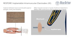 Implantable intramuscular electrodes capture individual muscle activity. When muscles are lost or injured, the IIE are implanted in regenerative peripheral nerve interface (RPNI) or targeted muscle reinnervation (TMR). Implantable intramuscular electrodes capture individual muscle activity. When muscles are lost or injured, the IIE are implanted in regenerative peripheral nerve interface (RPNI) or targeted muscle reinnervation (TMR).