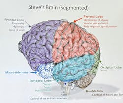 This simulation of Dr. Steve Levine’s brain allowed the large mass to be worked on virtually before the intricate surgery was performed. This simulation of Dr. Steve Levine’s brain allowed the large mass to be worked on virtually before the intricate surgery was performed.