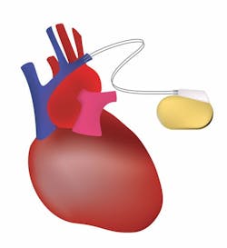 Traditional pacemaker illustration Traditional pacemaker illustration